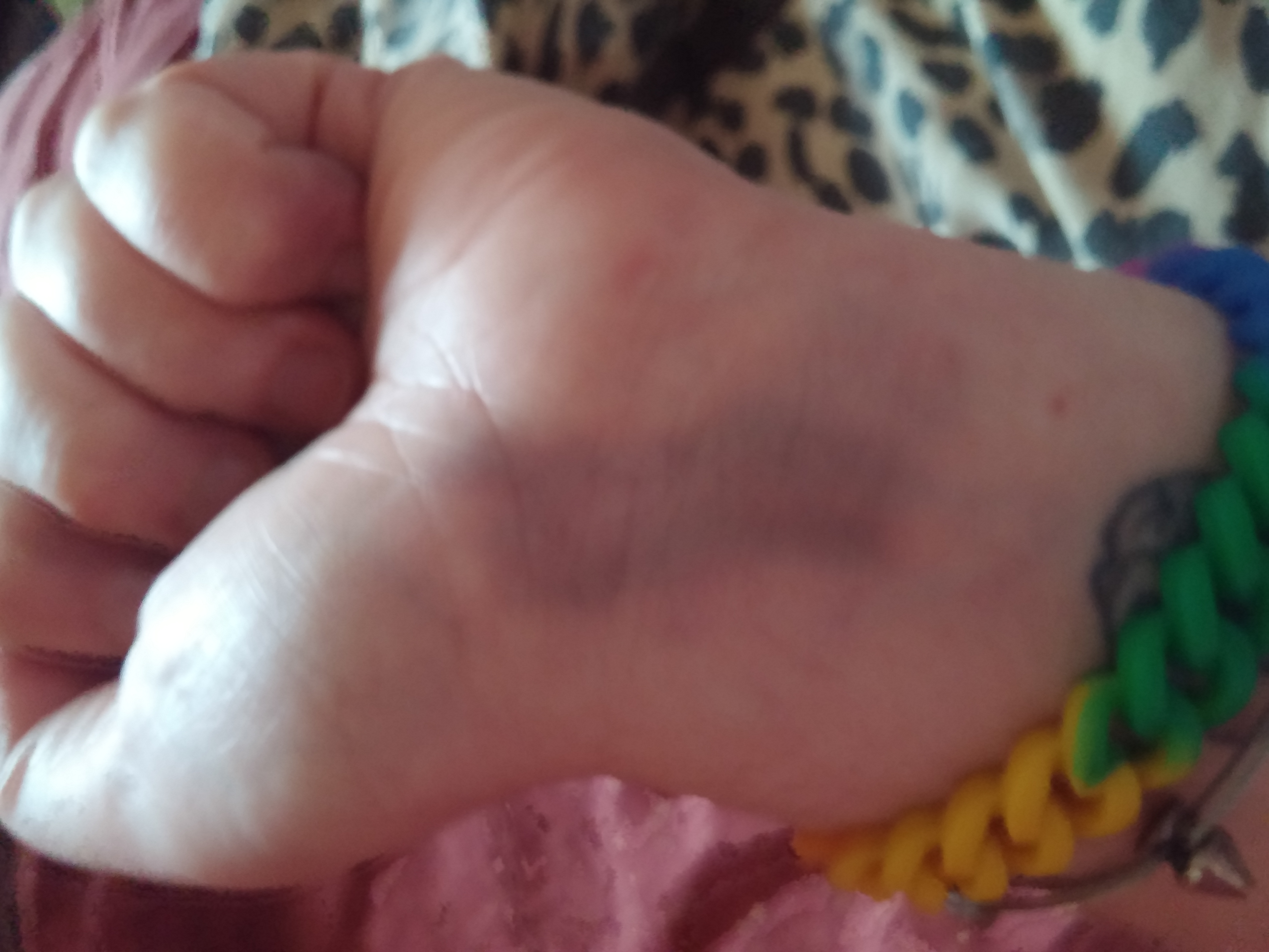 One of the pictures of some of the bruising 