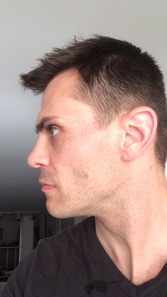 Profile before surgery 