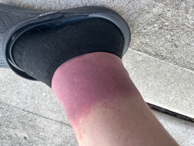 rising ABOVE the sock line, infection moving