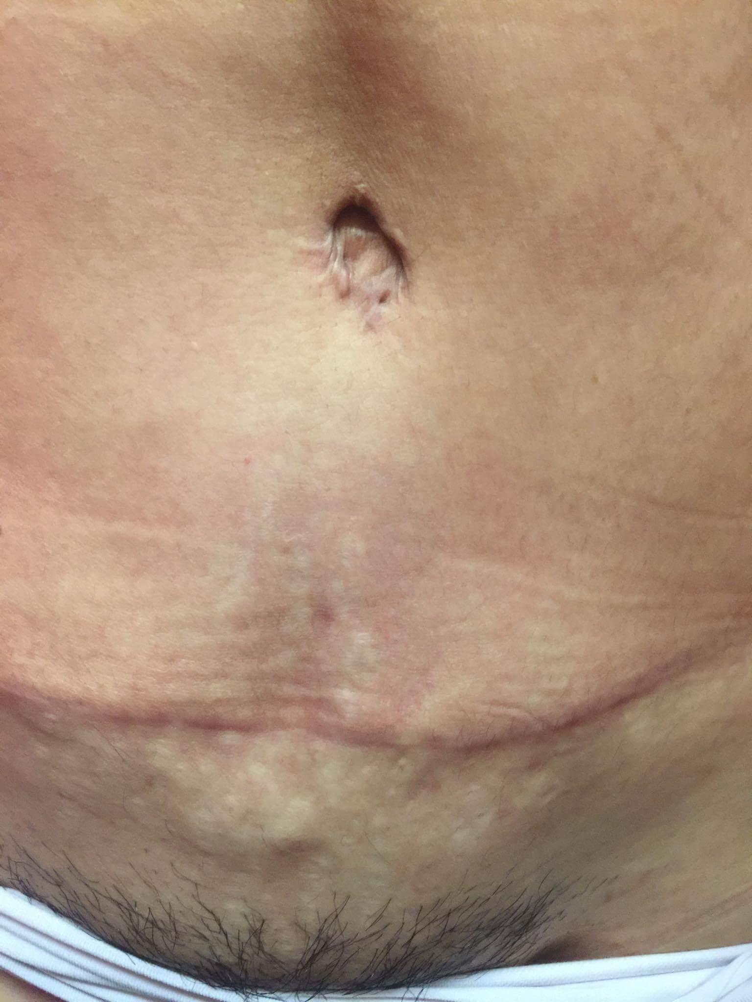 Tummy tuck cut completely crooked 