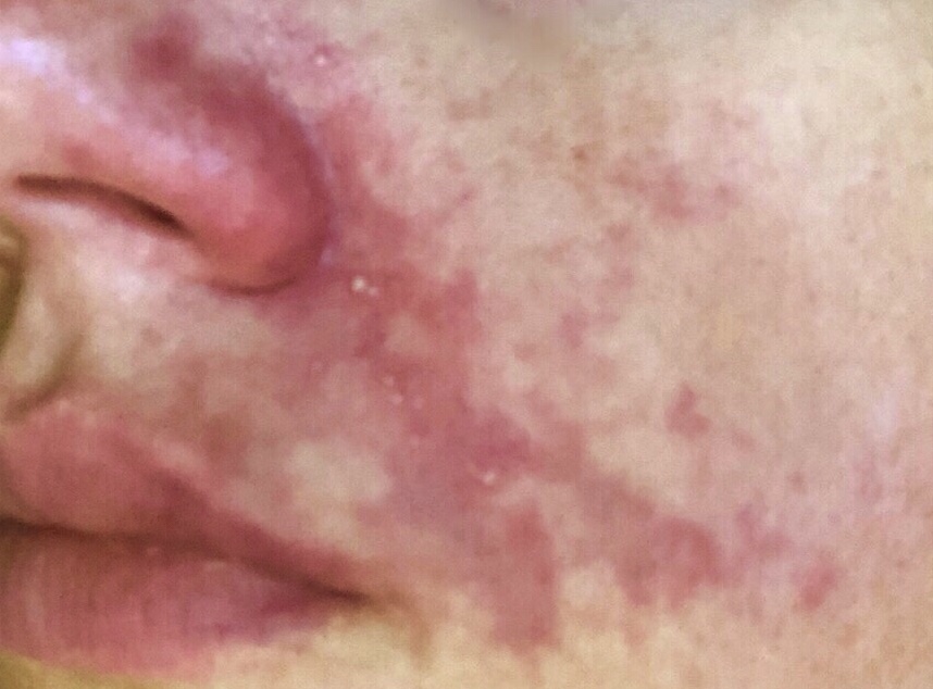Skin starting to have pustules from lack of oxygen