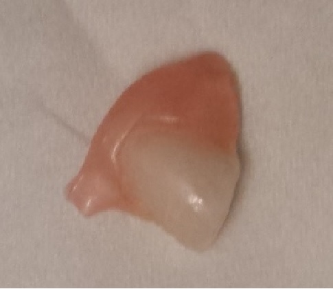 This tooth fell off Dr. Rubinoff's brand new dentu