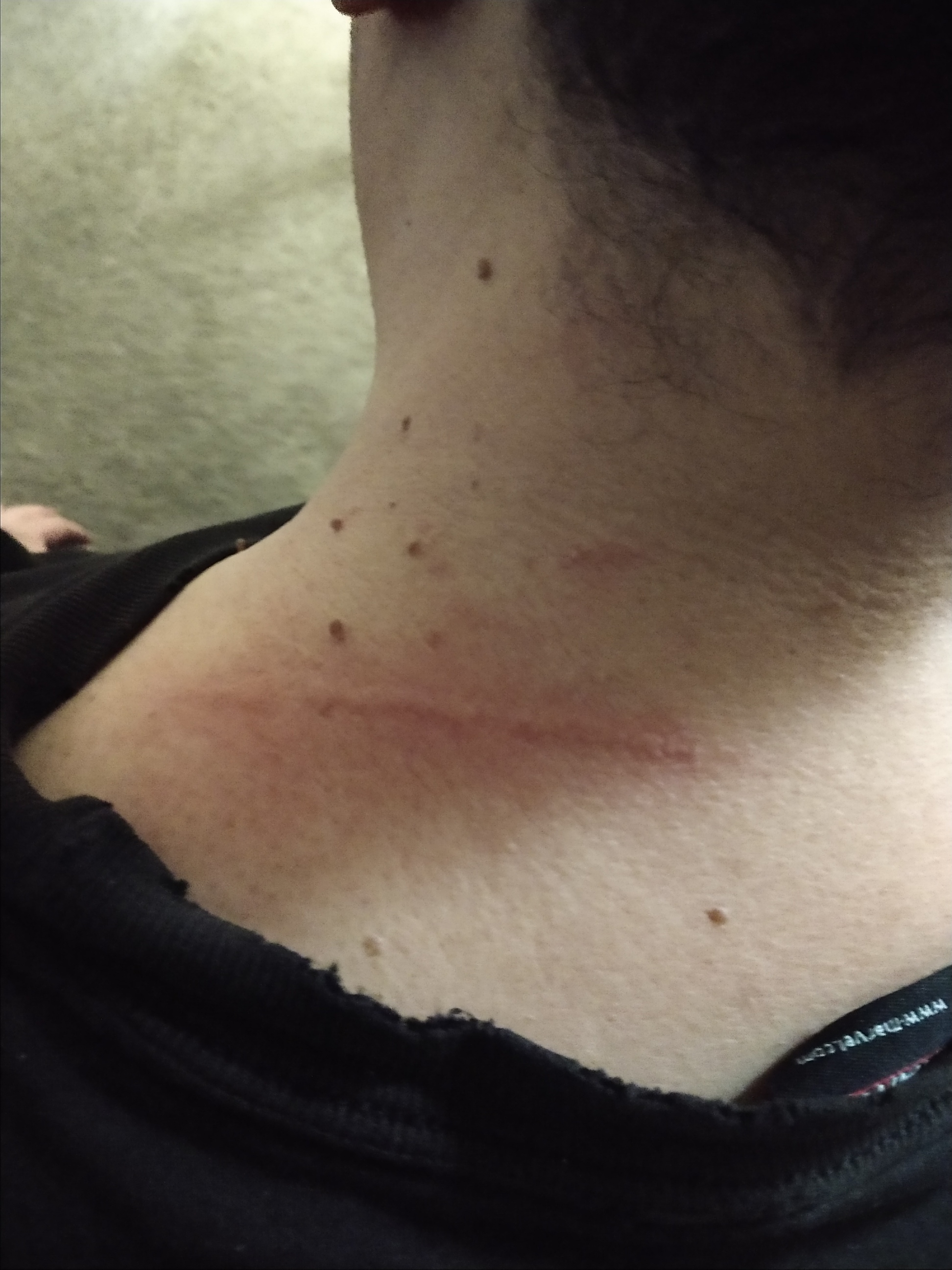 nasty welts on neck from sun 
