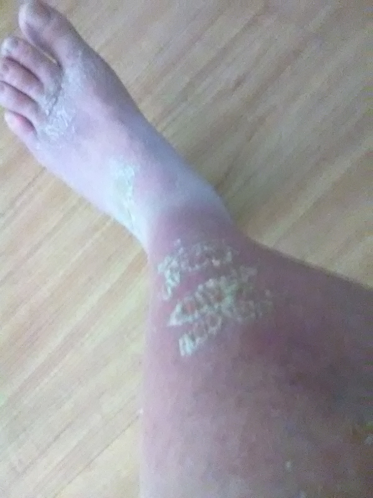 Chemical Burns From Horizon Milk On My Legs & Feet