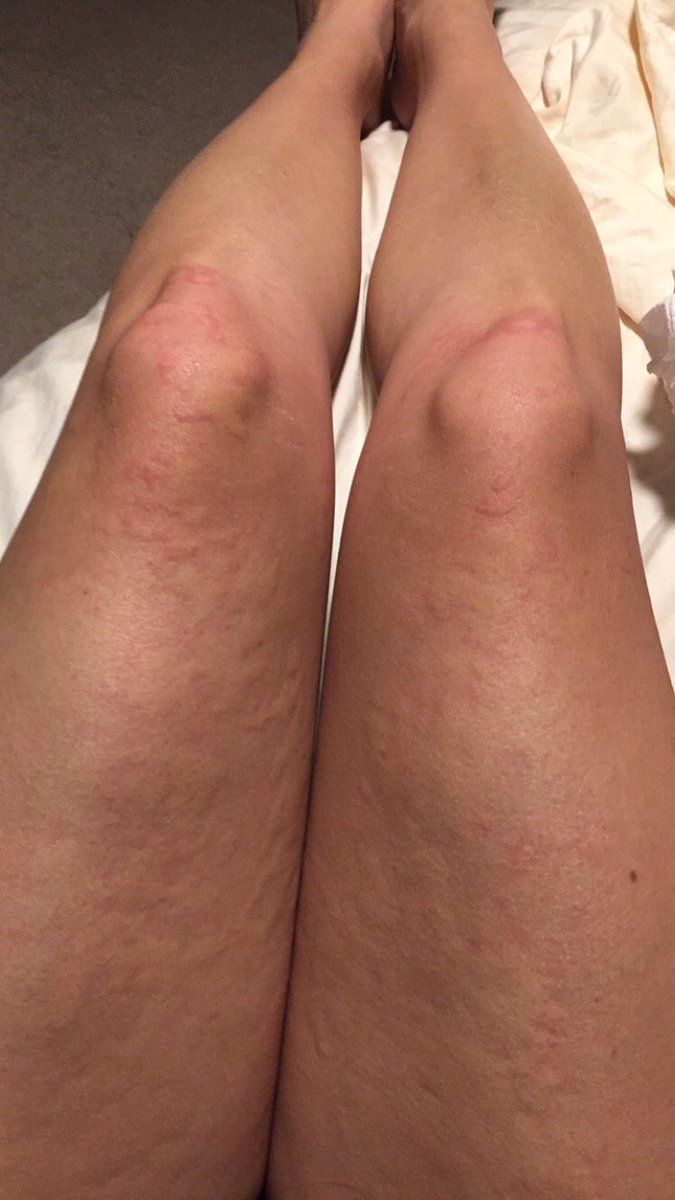 Reaction on my legs from beauty by earth 