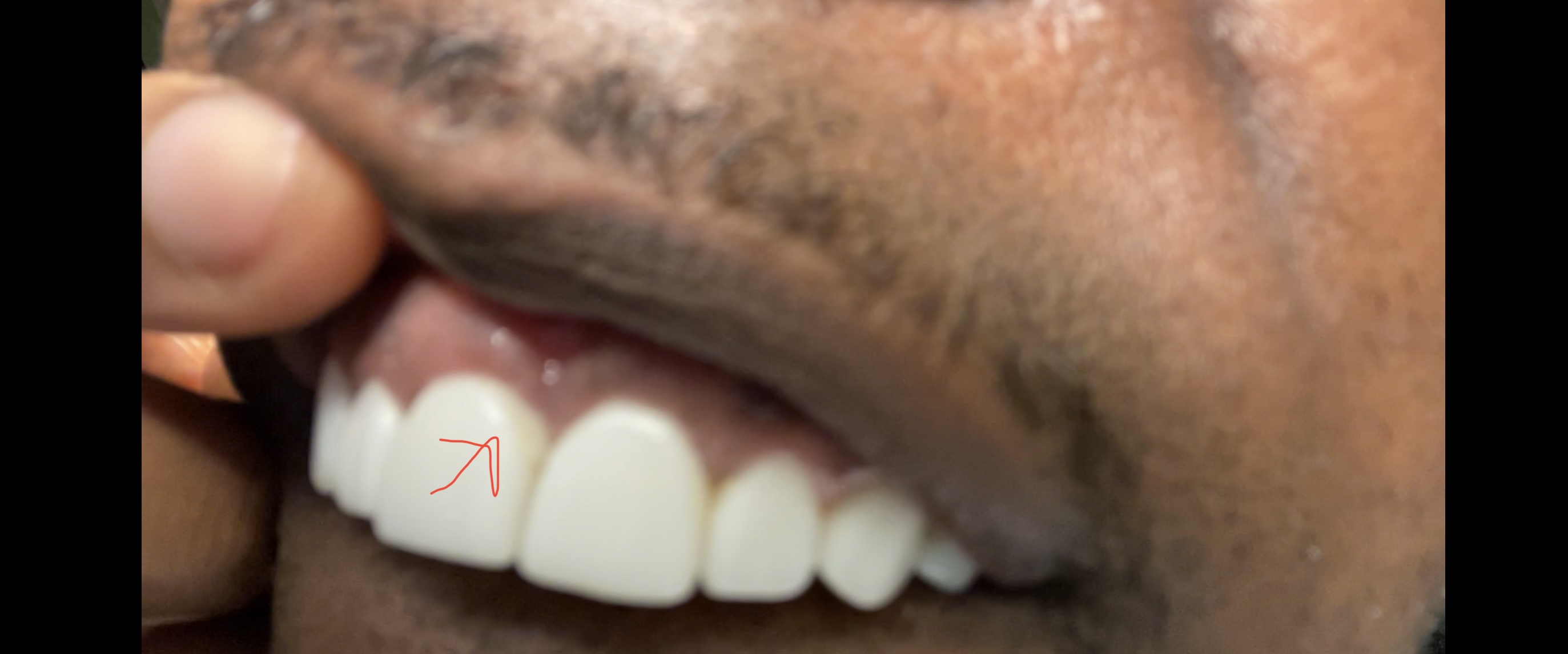 Chipped Veneers Second Angle