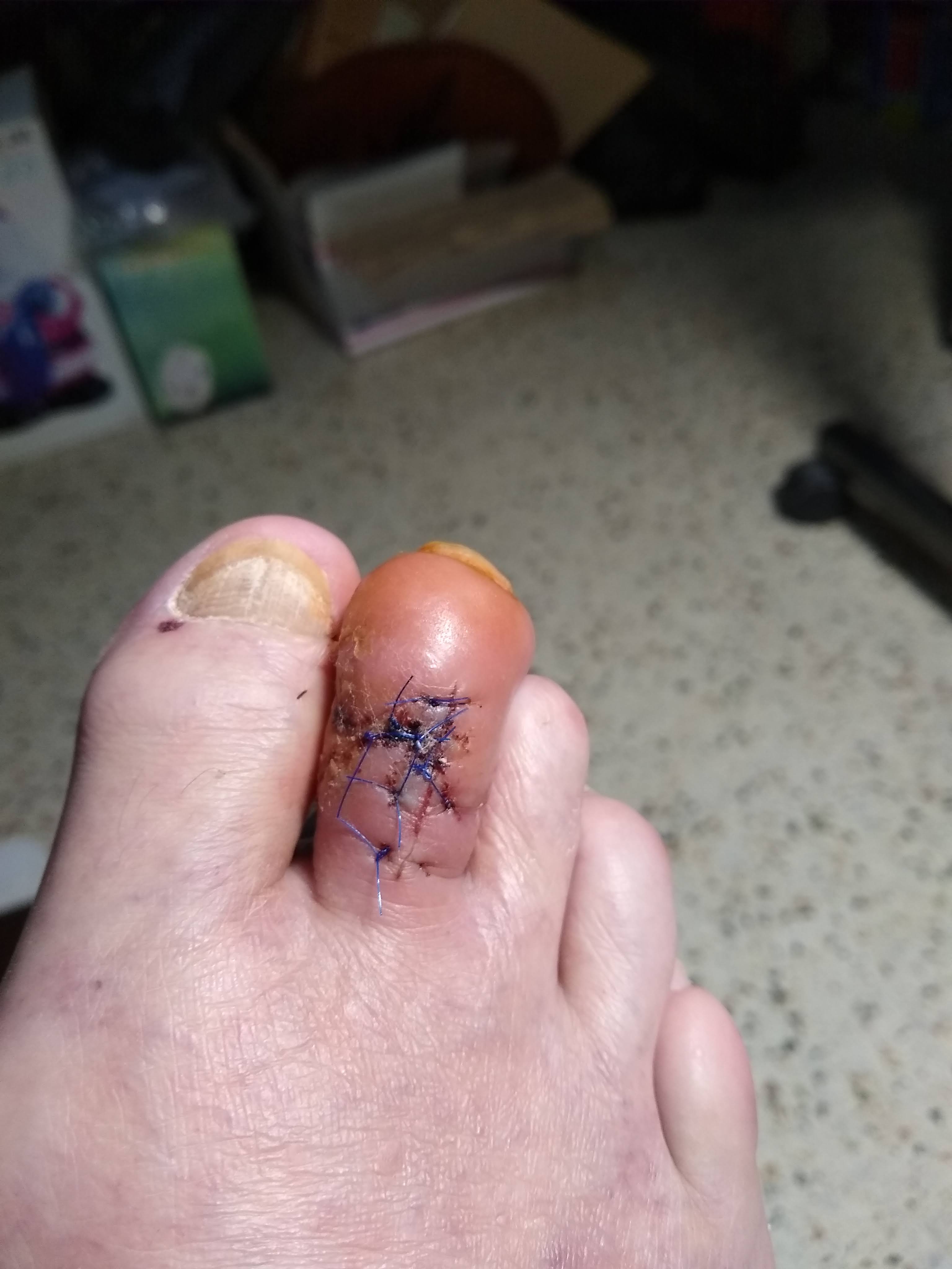 Toe after Surgery