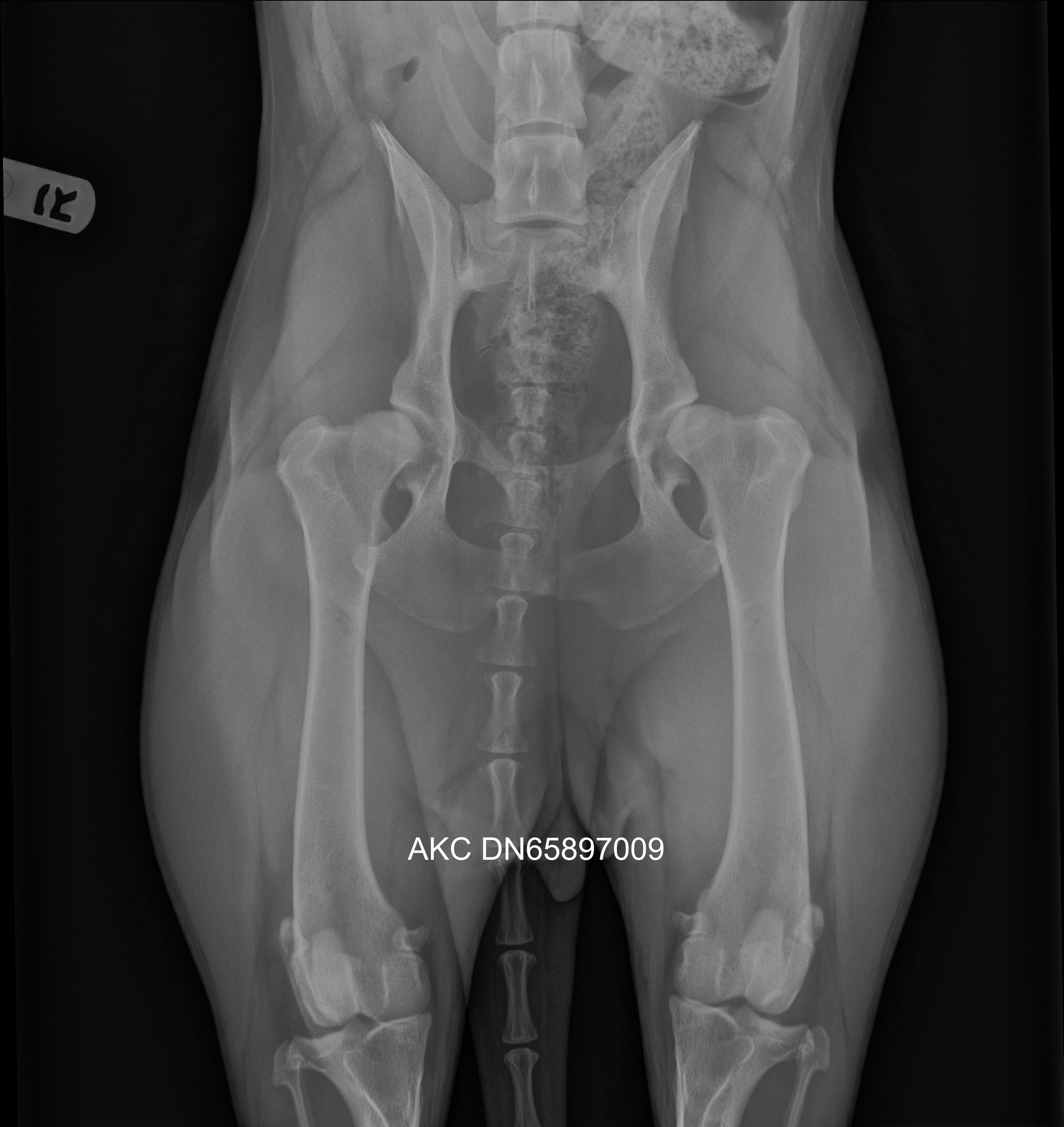 X-rays depicting Severe Hip Dysplasia