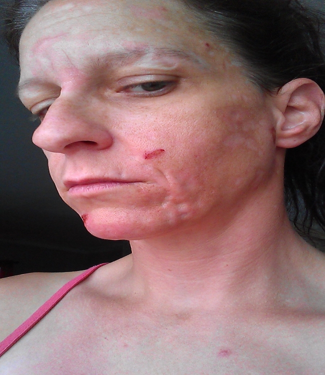 Susan Tanner Balanced Skin Care Center did this to me