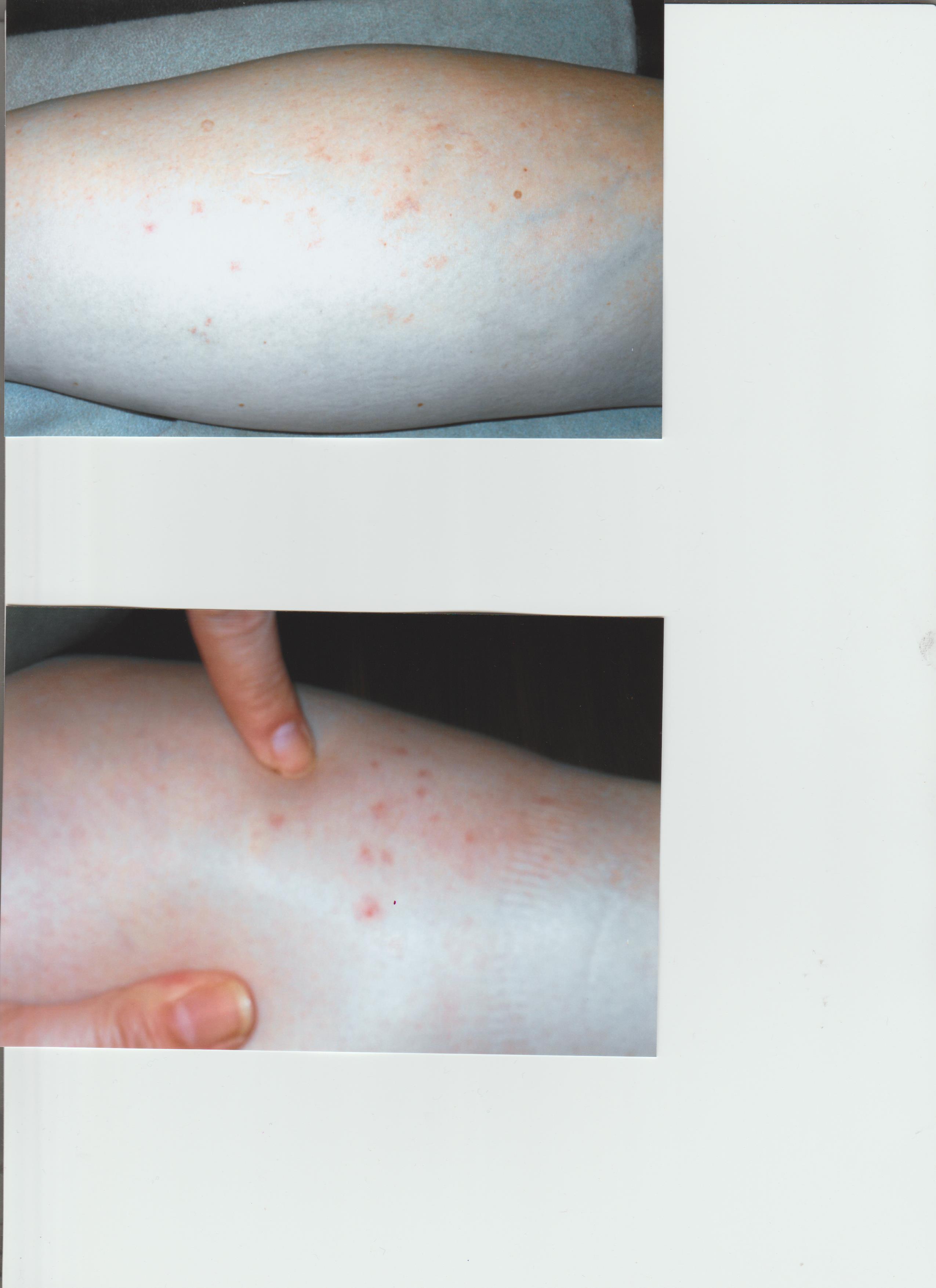 Rash on both legs.  It was worse than this.  My arms were covered in it.  My left arm got the worse of the chemical burn. 