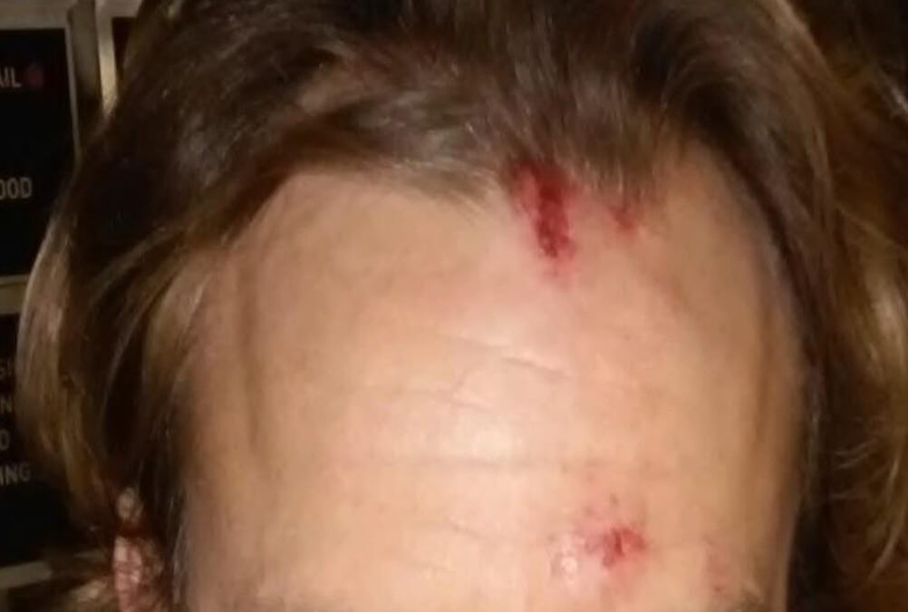 Open Head Wound: (Minutes After Attack).