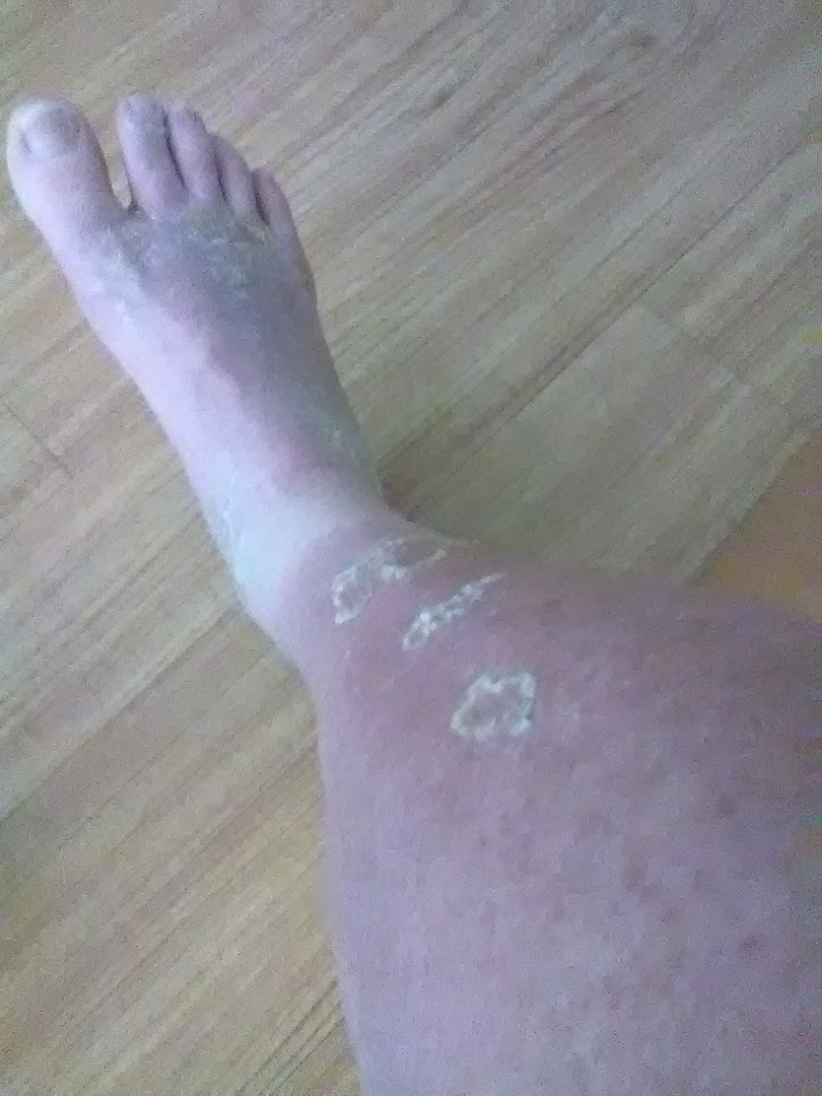 Chemical Burns From Ingested Poison On My Legs