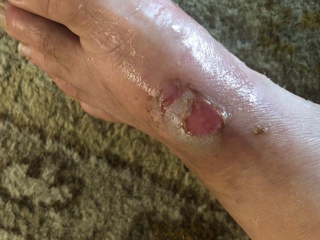 Fire ant bite infection