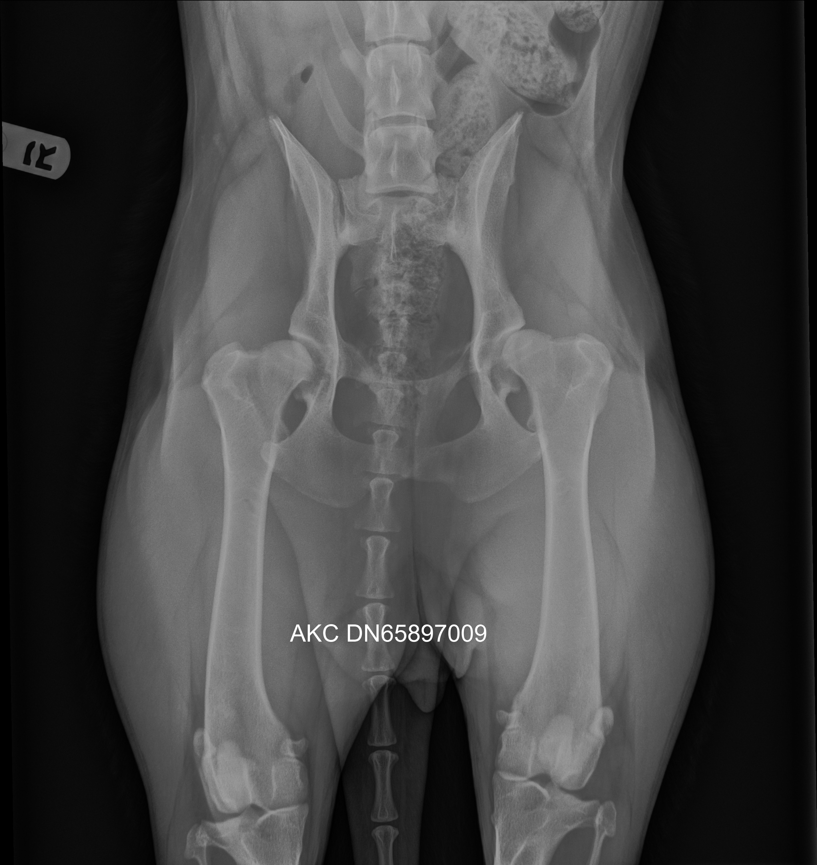 X-rays depicting Severe Hip Dysplasia