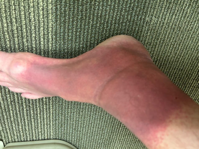 1-2 weeks after, still swollen and notice the colo